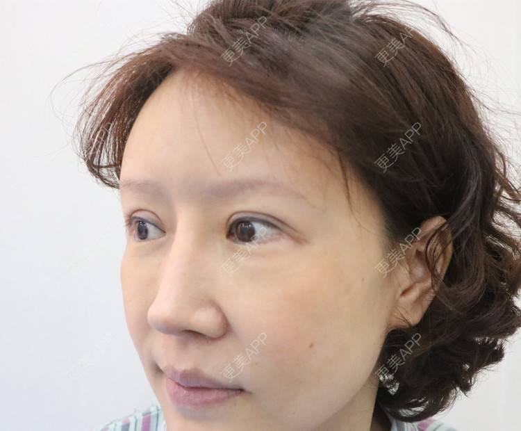 更美 - ⒈心只为你恳的综合去眼袋经验 | 眶隔脂肪释放 | 内切去眼袋 | 外切去眼袋 | 综合去眼袋 | 北京