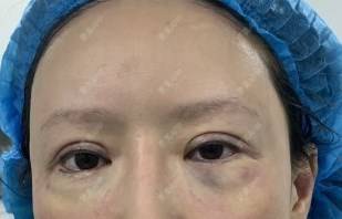 更美 - ⒈心只为你恳的综合去眼袋经验 | 眶隔脂肪释放 | 内切去眼袋 | 外切去眼袋 | 综合去眼袋 | 北京