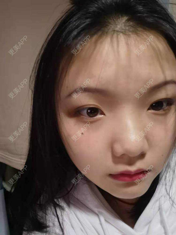 更美 - 达令达令狐的激光点痣经验 | 手术去胎记 | 激光淡斑 | 激光点痣 | 冷冻去痣 | 激光淡化红血丝 | 综合淡疤 | 注射淡疤 | 激光淡疤 | 皮秒激光 | 激光淡化胎记