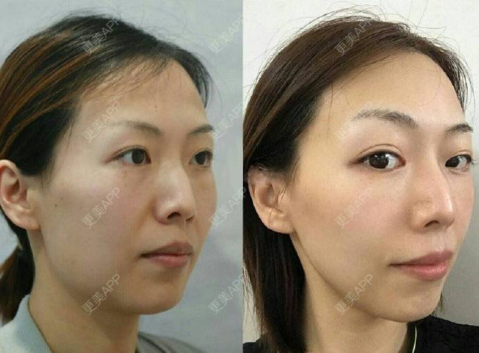 更美 - 重庆沙坪坝玺悦台医疗美容门诊有限公司的热玛吉经验 | 热玛吉 | 重庆