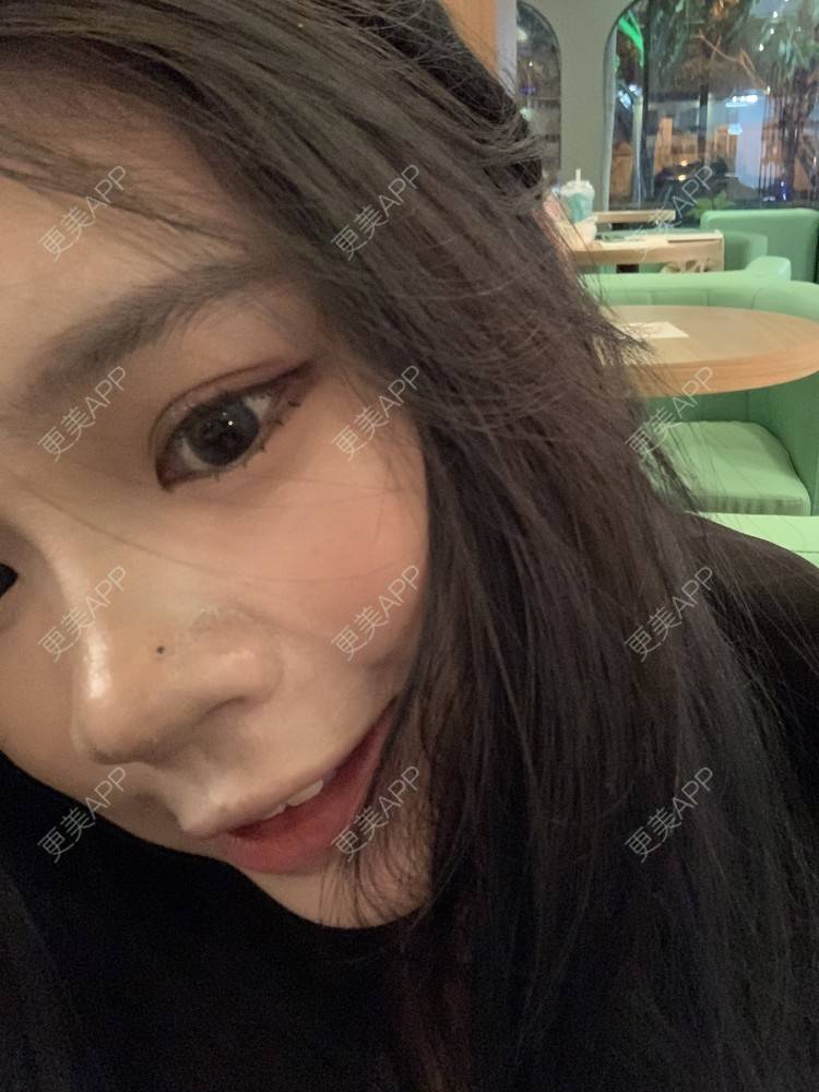 更美 - 更美用户DWKIxrCW9n的玻尿酸鼻部经验 | 玻尿酸鼻部 | 玻尿酸下巴 | 广州