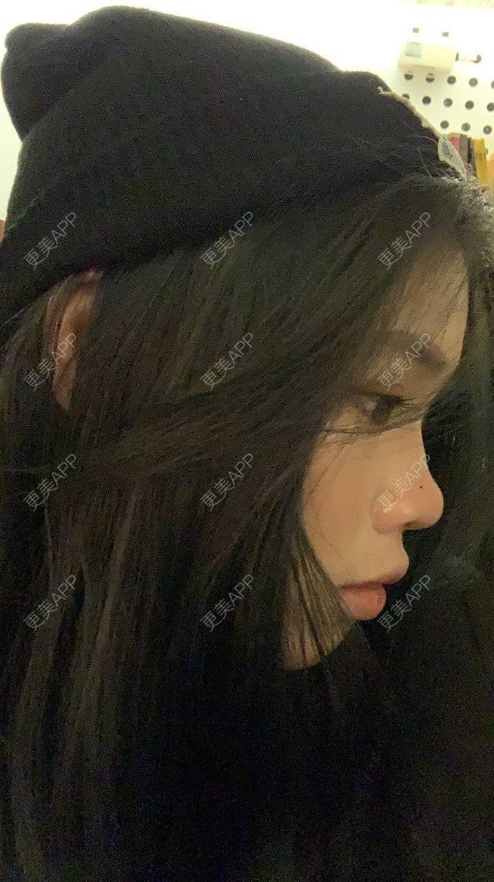 更美 - 更美用户DWKIxrCW9n的玻尿酸鼻部经验 | 玻尿酸鼻部 | 玻尿酸下巴 | 广州