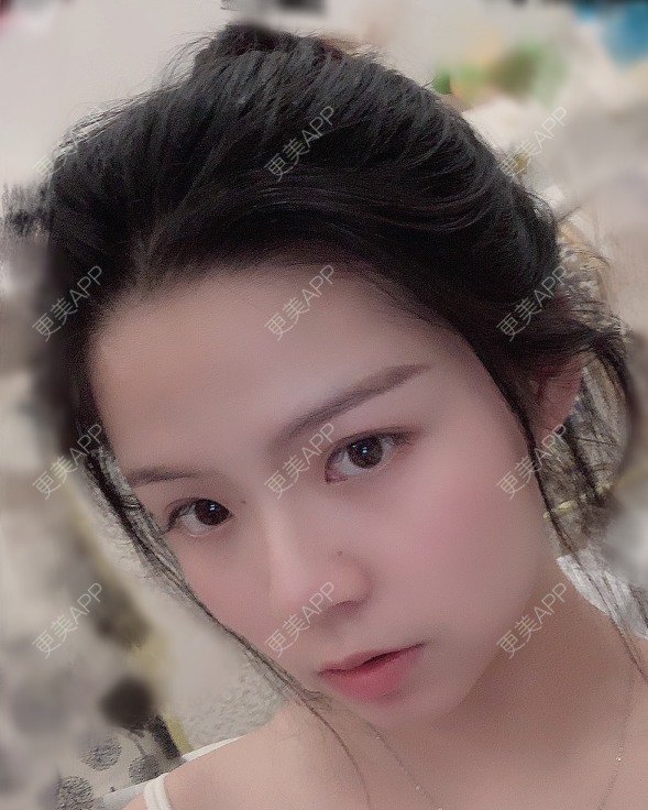 更美 - 更美用户8cGlQgtMJv的超声溶脂瘦腹部经验 | 超声溶脂瘦腹部 | 超声溶脂