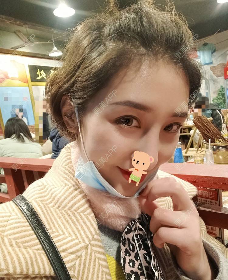 更美 - 更美用户1ieoNiY7aB的植发际线经验 | 北京 | 植发际线 | 毛发移植