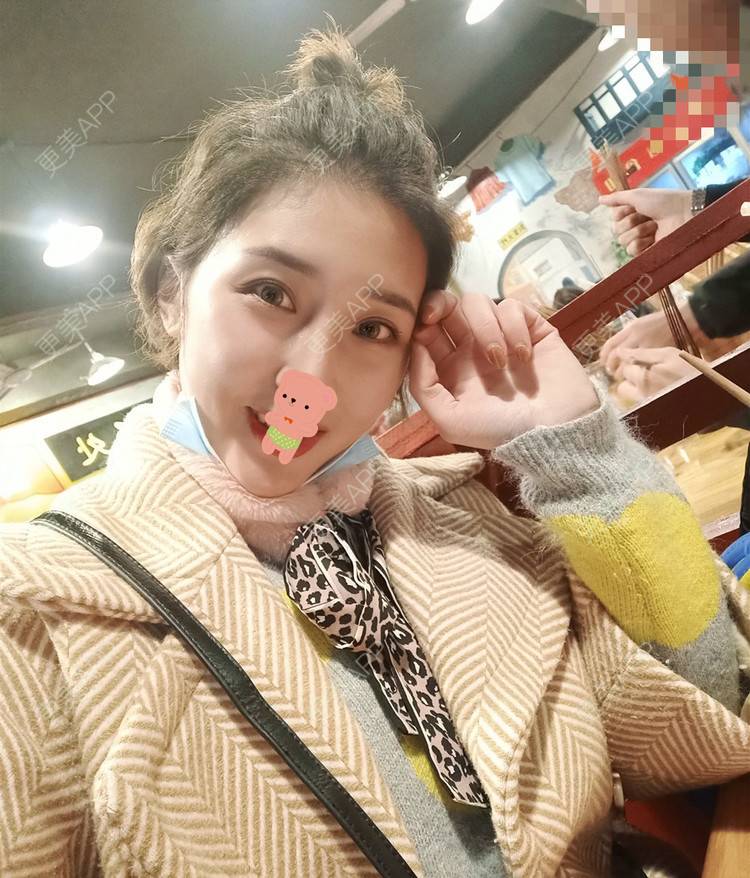 更美 - 更美用户1ieoNiY7aB的植发际线经验 | 北京 | 植发际线 | 毛发移植