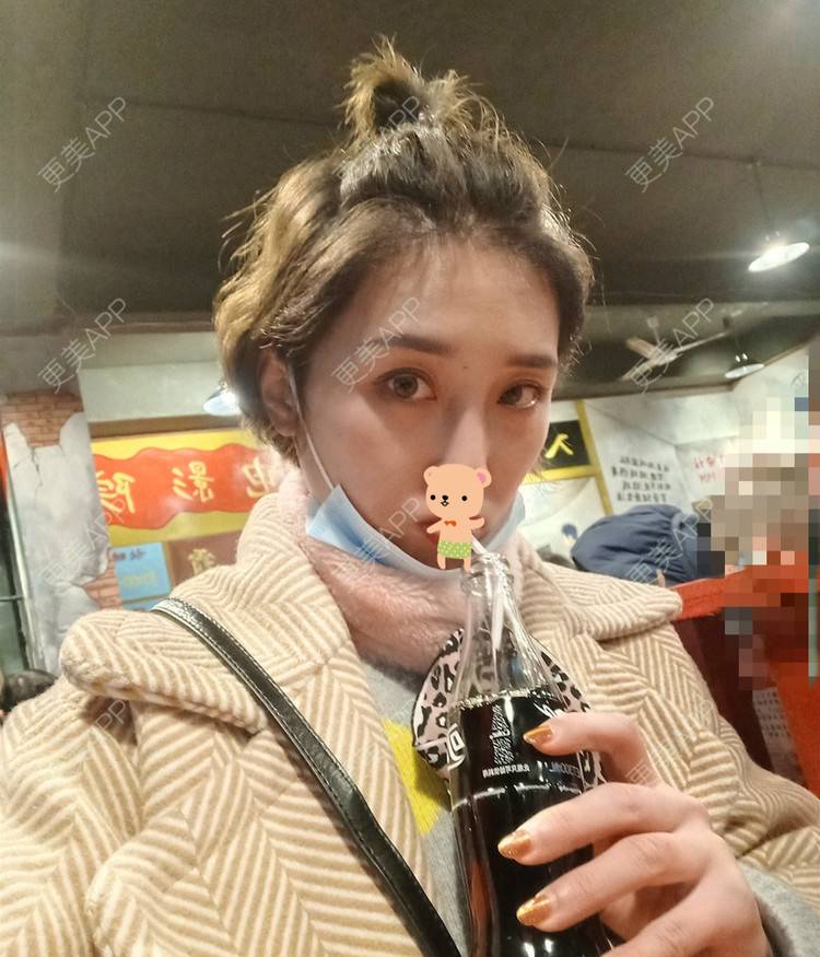 更美 - 更美用户1ieoNiY7aB的植发际线经验 | 北京 | 植发际线 | 毛发移植