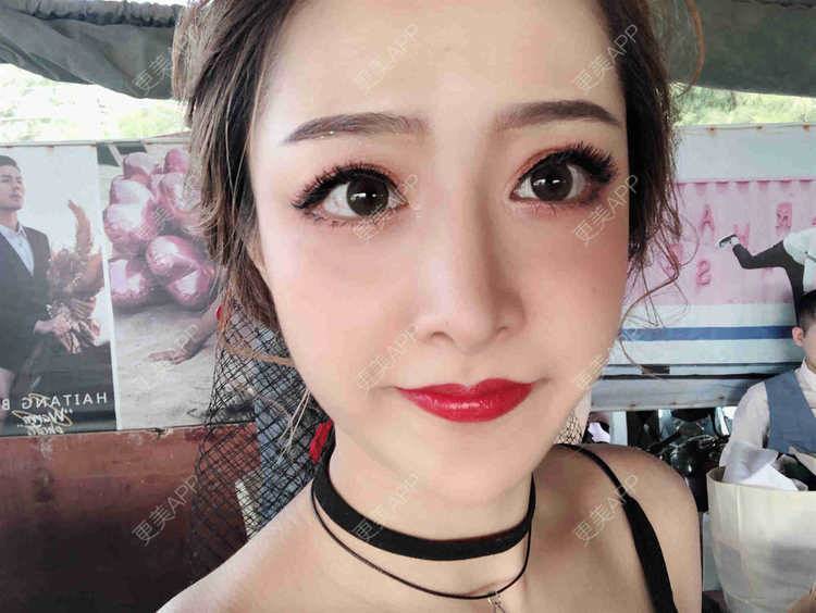 更美 - 诗雨y的鼻部多项经验 | 视频日记 | 重庆 | 肋软骨隆鼻 | 驼峰鼻矫正 | 鼻部多项 | 鼻翼缩小