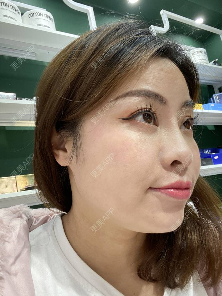更美 - 更美用户CLXgCqe6Kj的黑脸娃娃经验 | 光子嫩肤 | 白瓷娃娃 | 彩光嫩肤 | 黑脸娃娃 | 美白套餐 | 激光淡化红血丝 | 像素激光