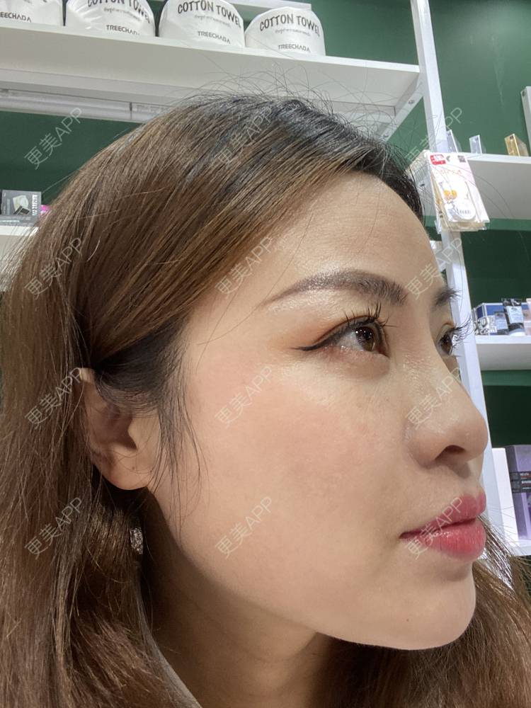 更美 - 更美用户CLXgCqe6Kj的黑脸娃娃经验 | 光子嫩肤 | 白瓷娃娃 | 彩光嫩肤 | 黑脸娃娃 | 美白套餐 | 激光淡化红血丝 | 像素激光