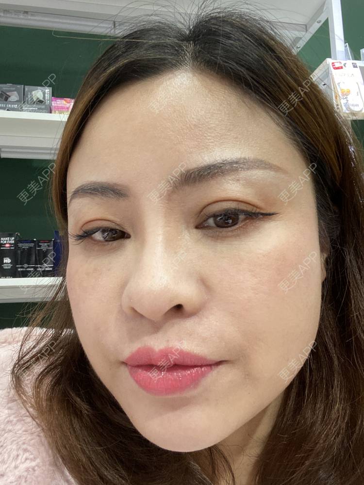 更美 - 更美用户CLXgCqe6Kj的黑脸娃娃经验 | 光子嫩肤 | 白瓷娃娃 | 彩光嫩肤 | 黑脸娃娃 | 美白套餐 | 激光淡化红血丝 | 像素激光