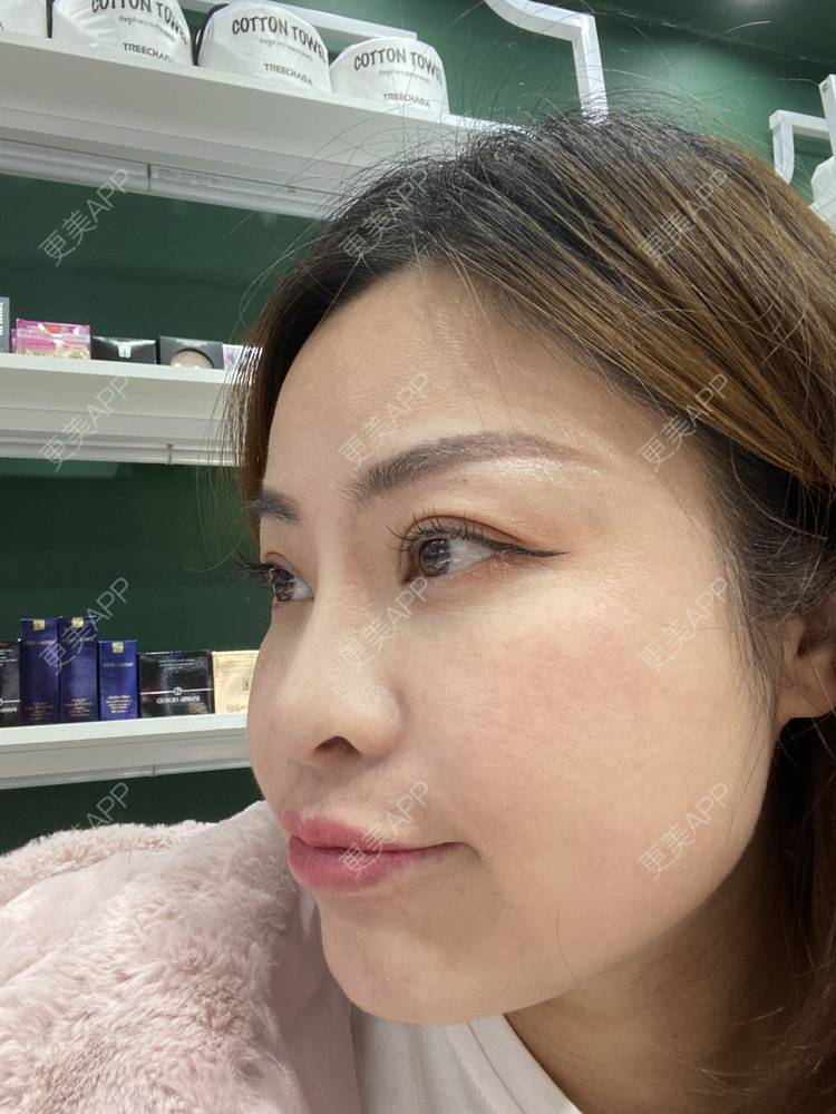 更美 - 更美用户CLXgCqe6Kj的黑脸娃娃经验 | 光子嫩肤 | 白瓷娃娃 | 彩光嫩肤 | 黑脸娃娃 | 美白套餐 | 激光淡化红血丝 | 像素激光