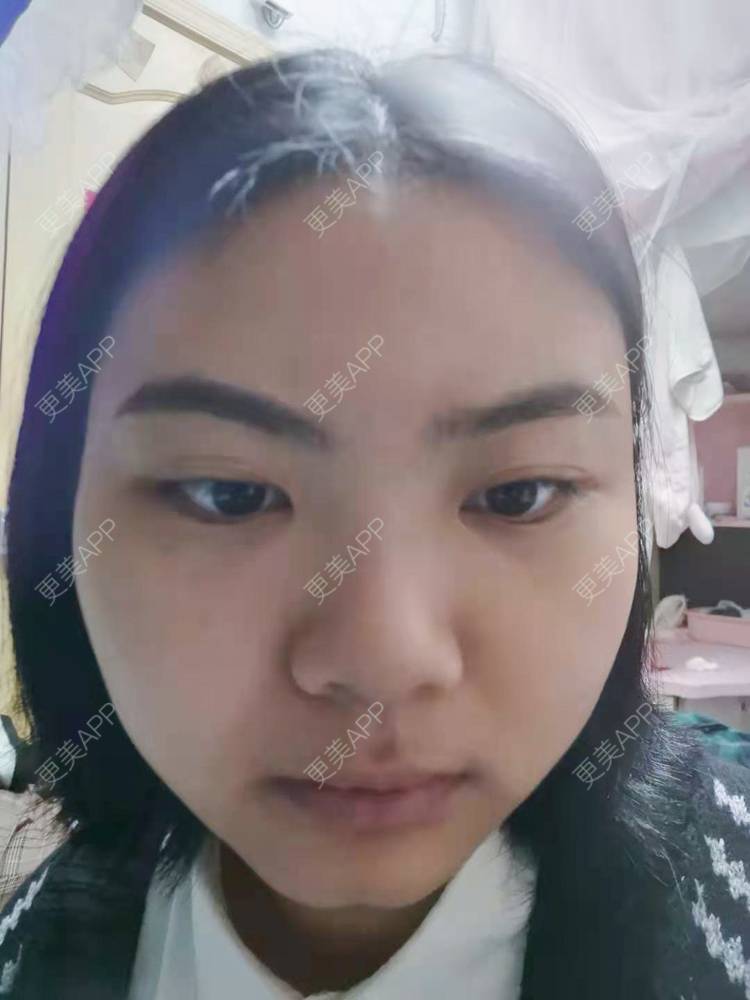 更美 - 不一“斑”的人的激光淡化红血丝经验 | 激光淡斑 | 淡斑套餐 | 激光淡化红血丝 | 点阵激光 | 光子嫩肤 | 像素激光 | 皮秒激光