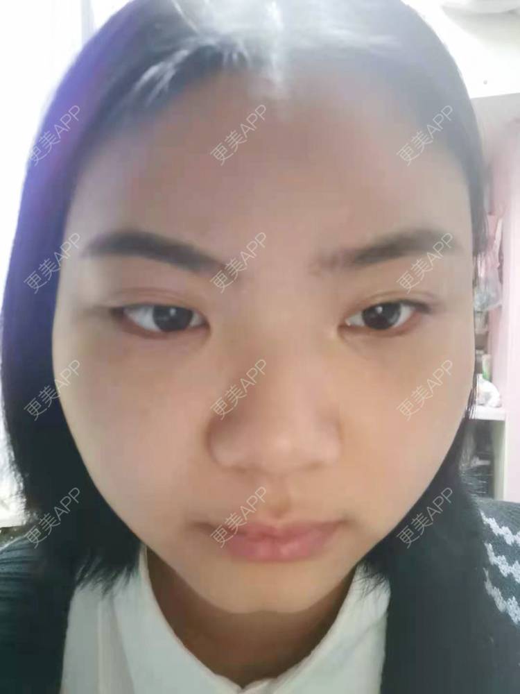 更美 - 不一“斑”的人的激光淡化红血丝经验 | 激光淡斑 | 淡斑套餐 | 激光淡化红血丝 | 点阵激光 | 光子嫩肤 | 像素激光 | 皮秒激光