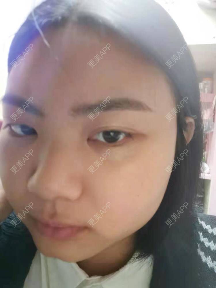 更美 - 不一“斑”的人的激光淡化红血丝经验 | 激光淡斑 | 淡斑套餐 | 激光淡化红血丝 | 点阵激光 | 光子嫩肤 | 像素激光 | 皮秒激光