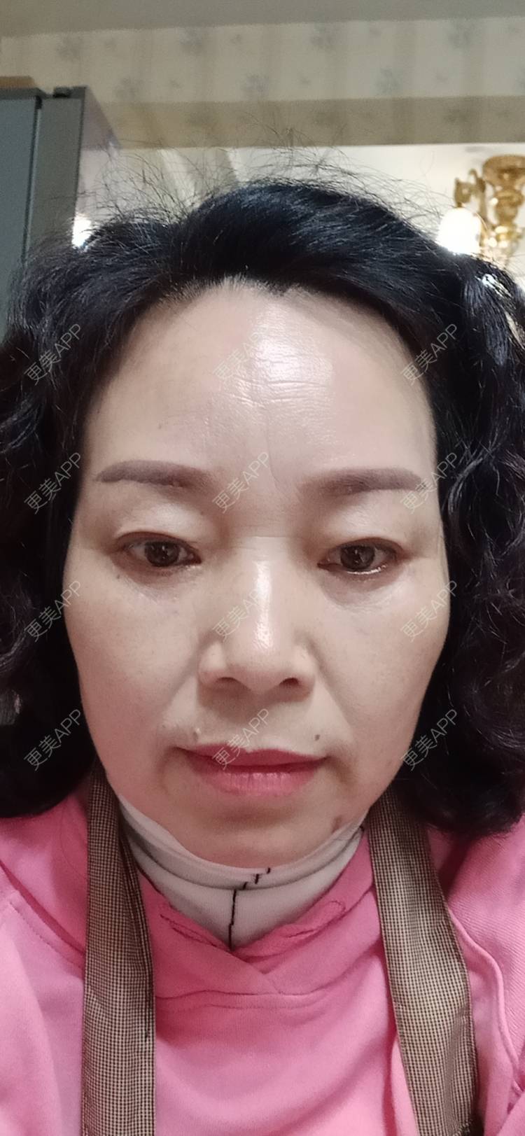 更美 - 更美用户sXiEl3rVrN的切眉经验 | 北京 | 内切去眼袋 | 眼部综合 | 切眉