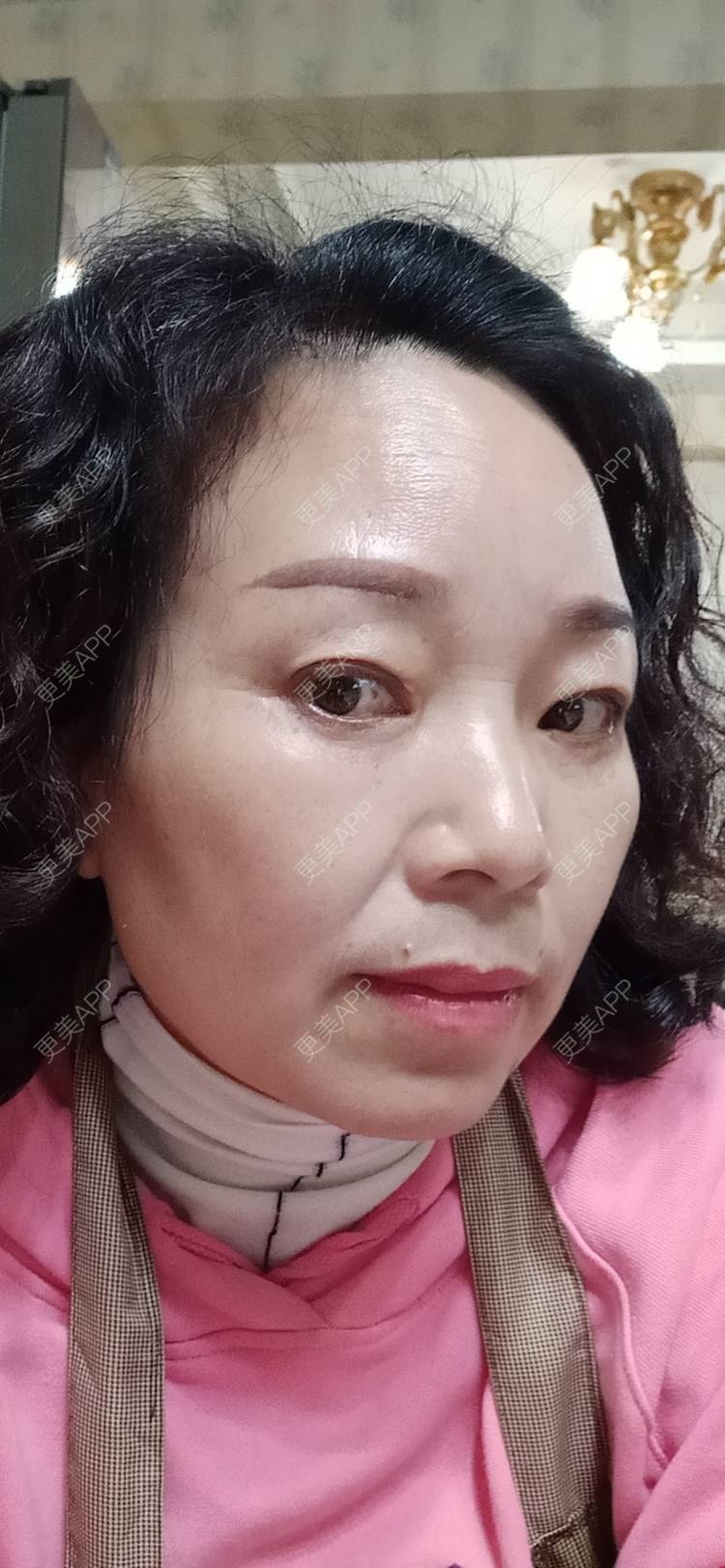 更美 - 更美用户sXiEl3rVrN的切眉经验 | 北京 | 内切去眼袋 | 眼部综合 | 切眉