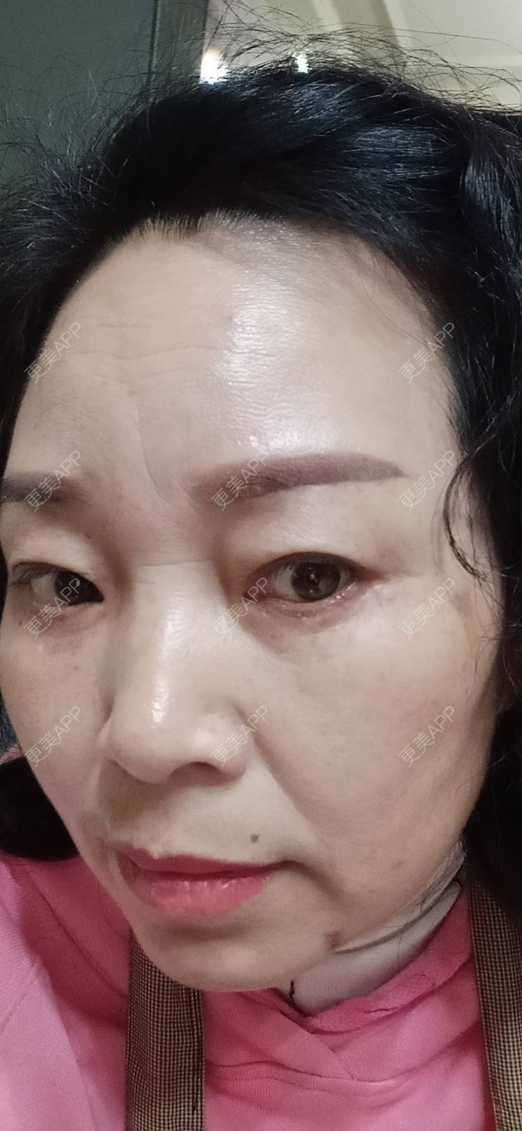 更美 - 更美用户sXiEl3rVrN的切眉经验 | 北京 | 内切去眼袋 | 眼部综合 | 切眉