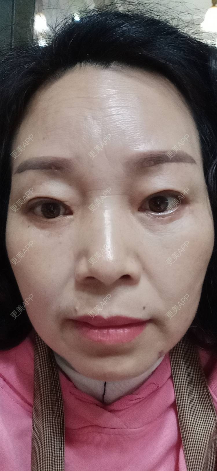 更美 - 更美用户sXiEl3rVrN的切眉经验 | 北京 | 内切去眼袋 | 眼部综合 | 切眉