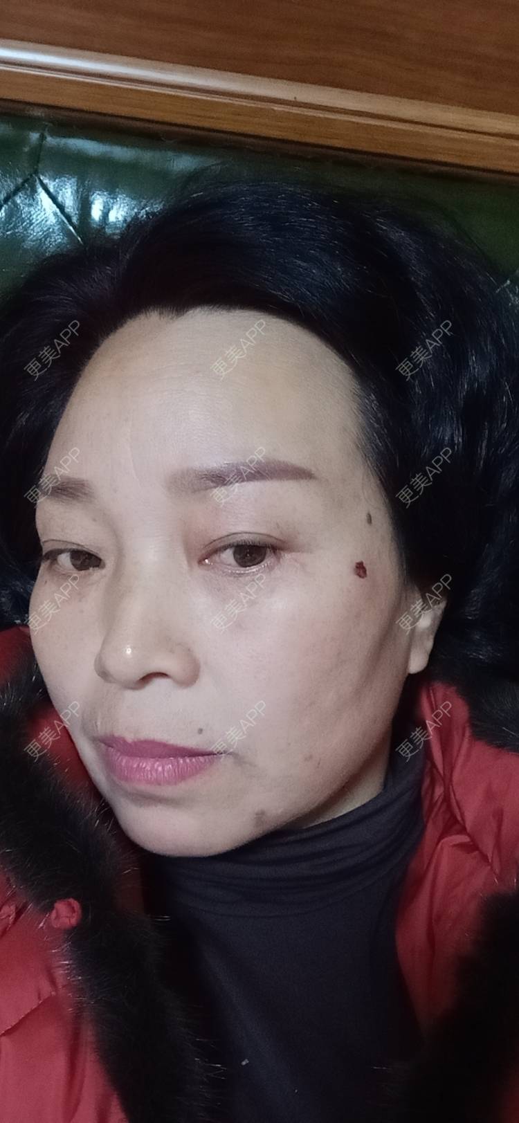 更美 - 更美用户sXiEl3rVrN的切眉经验 | 北京 | 内切去眼袋 | 切眉 | 提眉修复