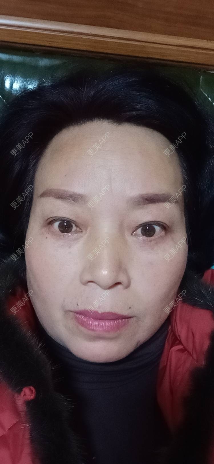 更美 - 更美用户sXiEl3rVrN的切眉经验 | 北京 | 内切去眼袋 | 切眉 | 提眉修复