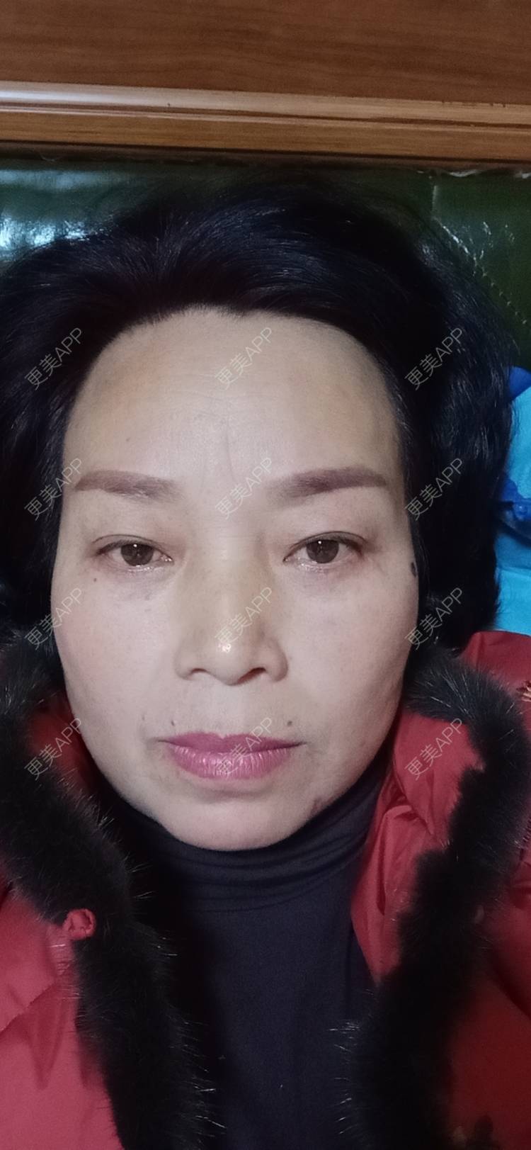 更美 - 更美用户sXiEl3rVrN的切眉经验 | 北京 | 内切去眼袋 | 切眉 | 提眉修复
