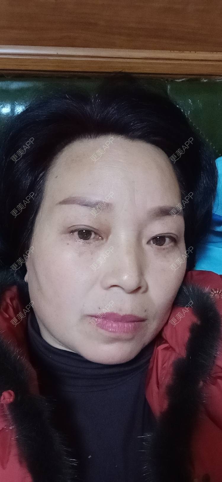 更美 - 更美用户sXiEl3rVrN的切眉经验 | 北京 | 内切去眼袋 | 切眉 | 提眉修复