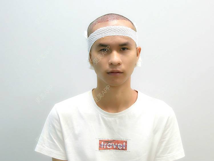 更美 - 更美用户P8KrUHueYa的植发际线经验 | 北京 | 植发际线 | 毛发移植