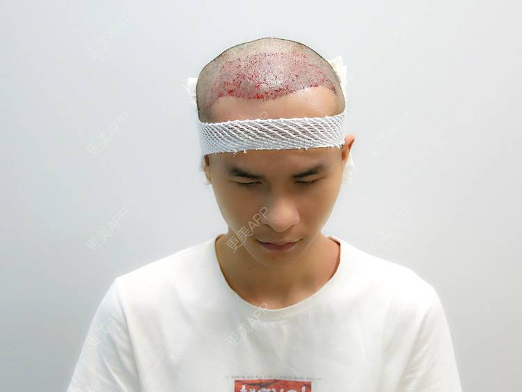 更美 - 更美用户P8KrUHueYa的植发际线经验 | 北京 | 植发际线 | 毛发移植