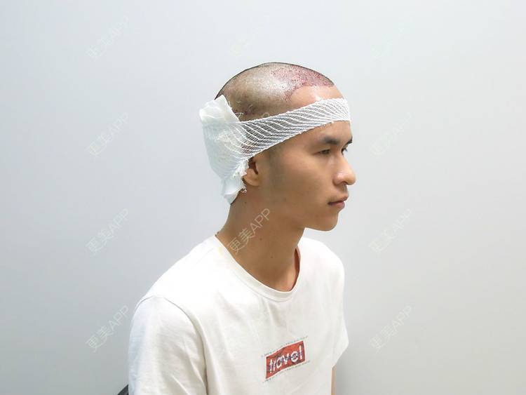 更美 - 更美用户P8KrUHueYa的植发际线经验 | 北京 | 植发际线 | 毛发移植