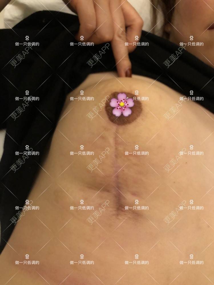 更美 - 更美用户ZN5LsrY6bk的乳晕缩小经验 | 乳晕缩小 | 缩胸手术 | 胸部下垂矫正 | 杭州