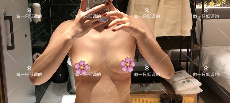更美 - 更美用户ZN5LsrY6bk的乳晕缩小经验 | 乳晕缩小 | 缩胸手术 | 胸部下垂矫正 | 杭州
