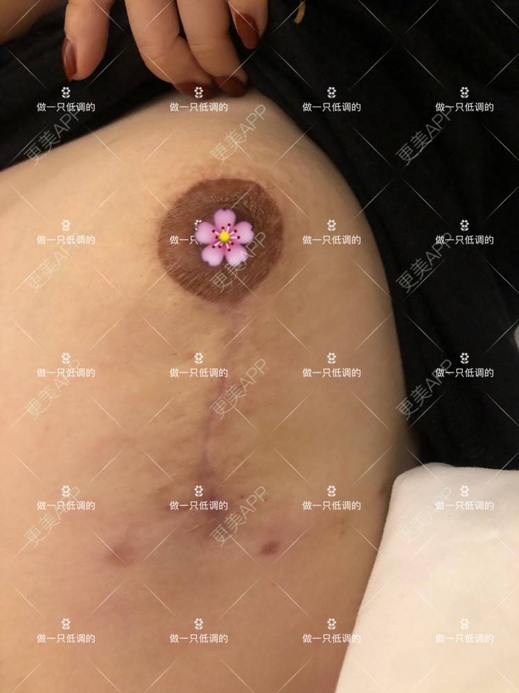 更美 - 更美用户ZN5LsrY6bk的乳晕缩小经验 | 乳晕缩小 | 缩胸手术 | 胸部下垂矫正 | 杭州