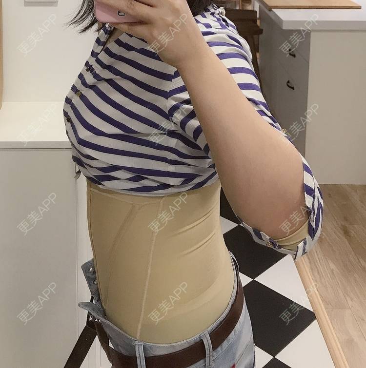 更美 - 更美用户iunQ5E7eHk的吸脂去副乳经验 | 北京 | 吸脂去副乳 | 视频日记