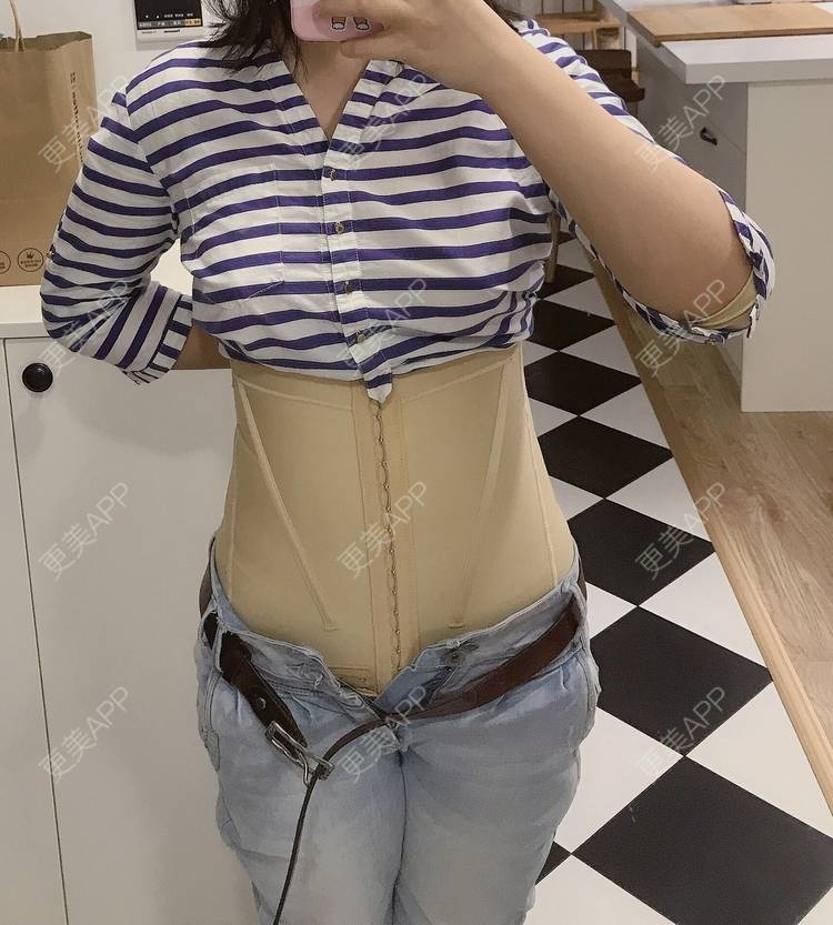 更美 - 更美用户iunQ5E7eHk的吸脂去副乳经验 | 北京 | 吸脂去副乳 | 视频日记