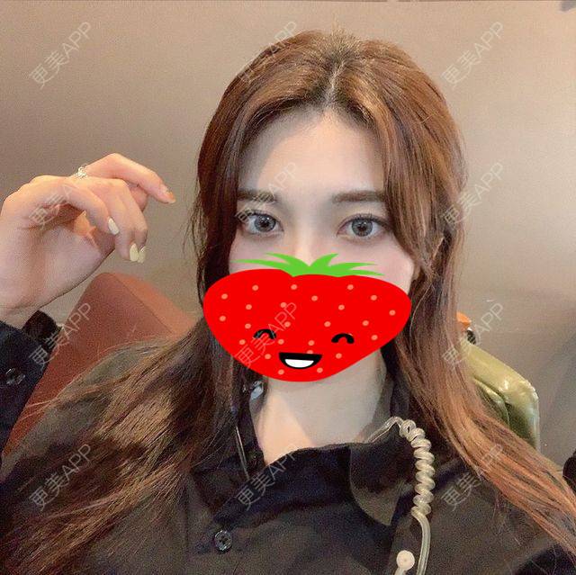 更美 - 无妨翰的膨体垫眉弓经验 | 膨体垫眉弓 | 上海