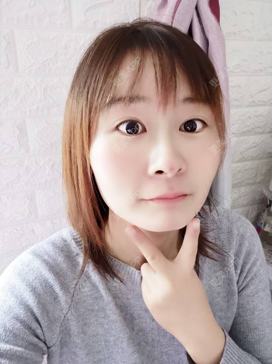 更美 - 更美用户srpv6JiXYY的玻尿酸苹果肌经验 | 玻尿酸苹果肌 | 上海