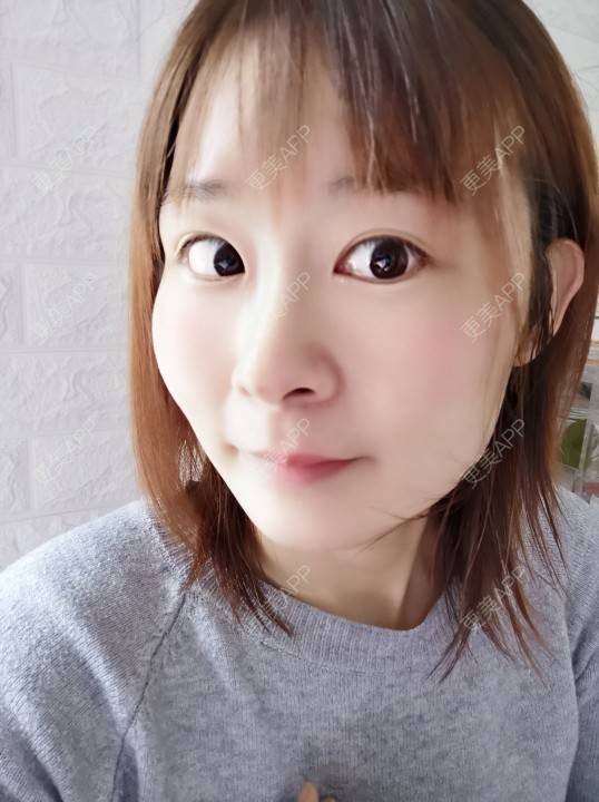 更美 - 更美用户srpv6JiXYY的玻尿酸苹果肌经验 | 玻尿酸苹果肌 | 上海