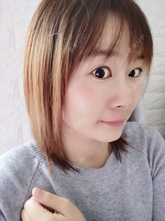 更美 - 更美用户srpv6JiXYY的玻尿酸苹果肌经验 | 玻尿酸苹果肌 | 上海