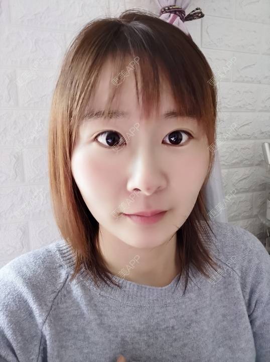 更美 - 更美用户srpv6JiXYY的玻尿酸苹果肌经验 | 玻尿酸苹果肌 | 上海