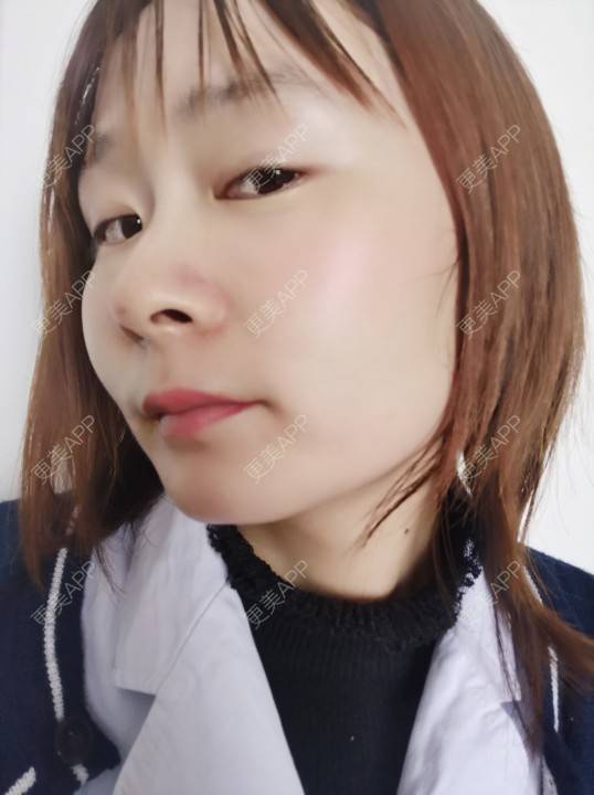 更美 - 更美用户srpv6JiXYY的玻尿酸苹果肌经验 | 玻尿酸苹果肌 | 上海