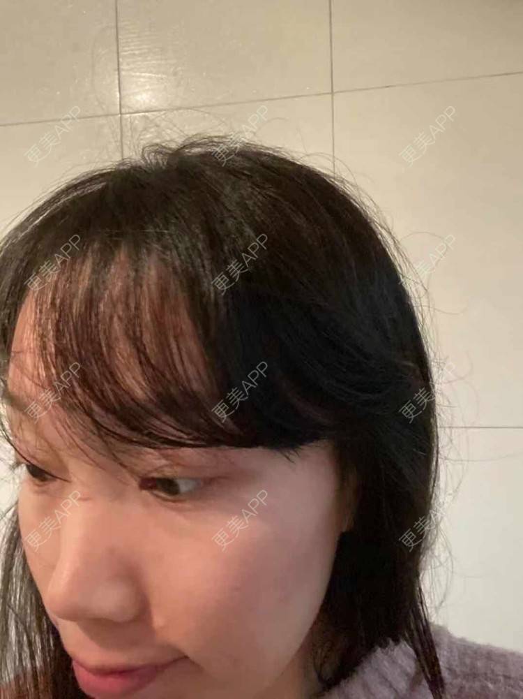 更美 - 更美用户QycERbZ0fv的鬓角植发经验 | 植发际线 | 毛发移植 | 鬓角植发 | 头顶加密种植 | 美人尖植发 | 武汉