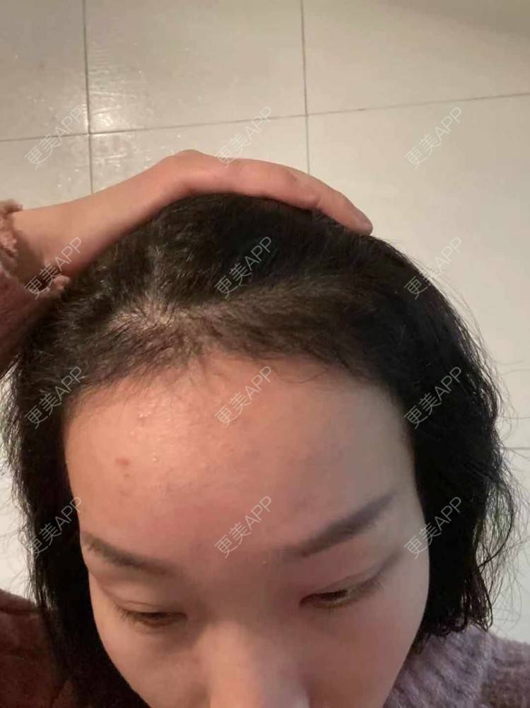 更美 - 更美用户QycERbZ0fv的鬓角植发经验 | 植发际线 | 毛发移植 | 鬓角植发 | 头顶加密种植 | 美人尖植发 | 武汉