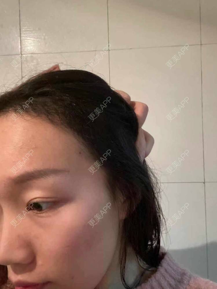 更美 - 更美用户QycERbZ0fv的鬓角植发经验 | 植发际线 | 毛发移植 | 鬓角植发 | 头顶加密种植 | 美人尖植发 | 武汉