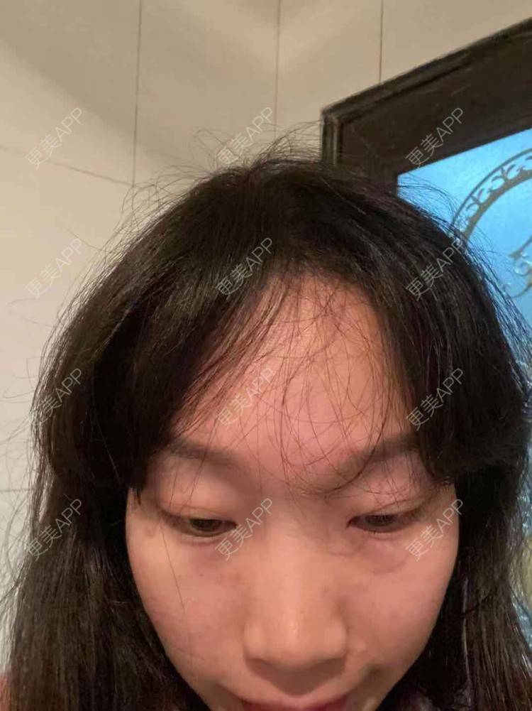 更美 - 更美用户QycERbZ0fv的鬓角植发经验 | 植发际线 | 毛发移植 | 鬓角植发 | 头顶加密种植 | 美人尖植发 | 武汉