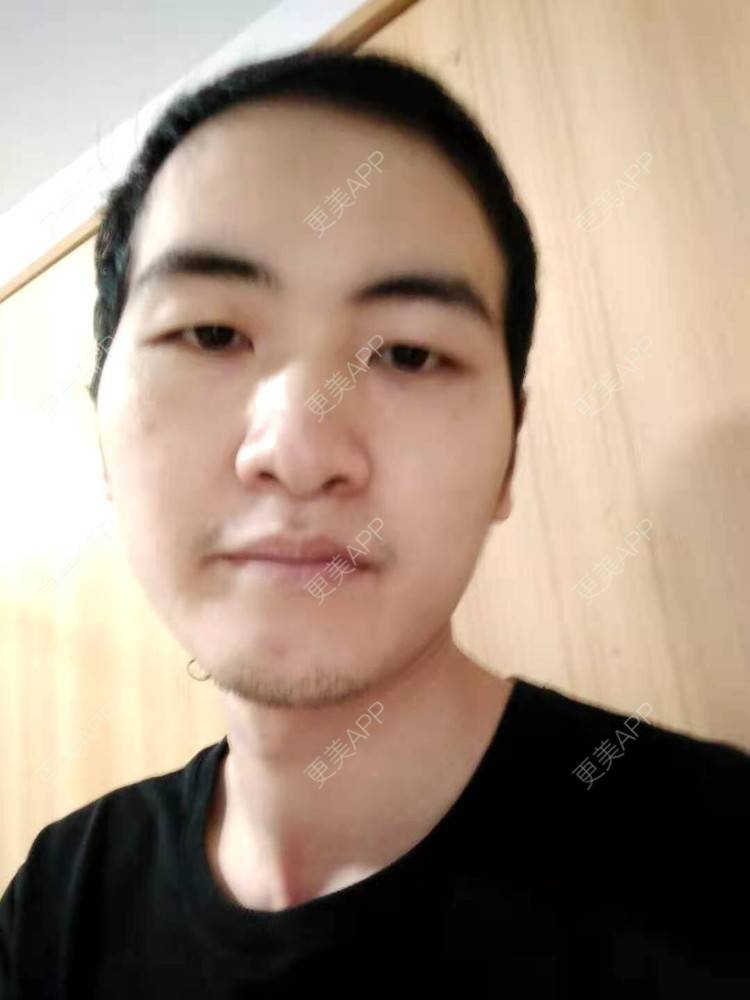 更美 - 更美用户udsA5GlrYX的鬓角植发经验 | 植发际线 | 毛发移植 | 鬓角植发 | 头顶加密种植 | 美人尖植发