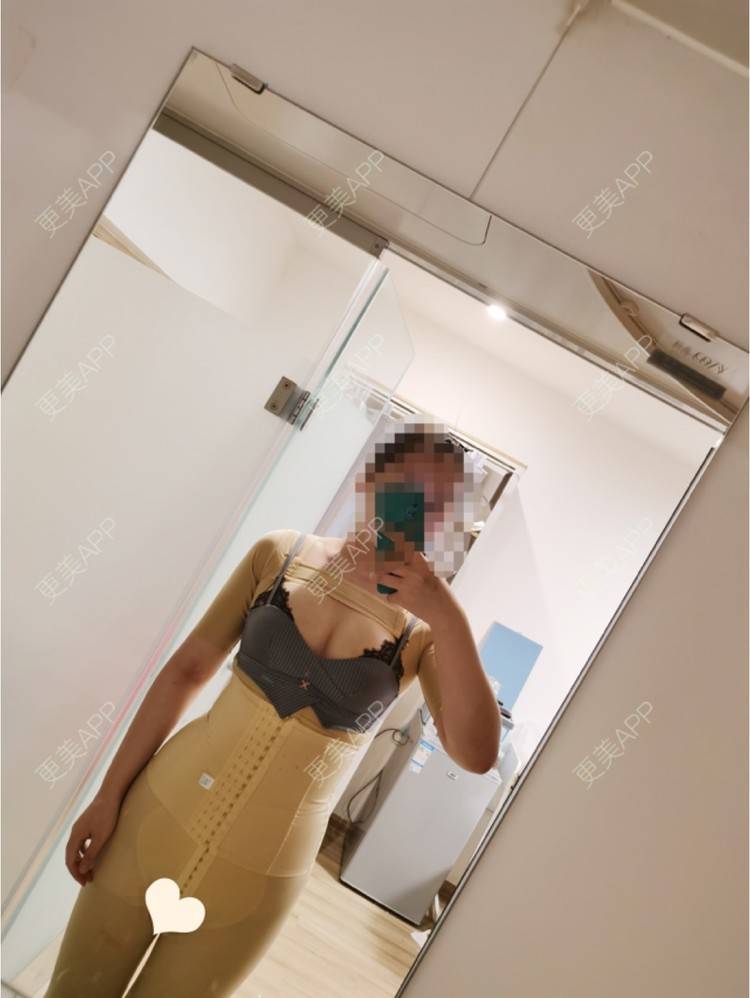 更美 - 更美用户U4weuuOb0x的吸脂去副乳经验 | 吸脂去副乳 | 北京