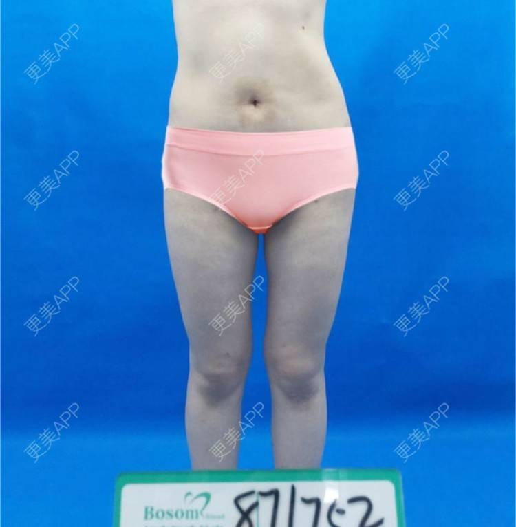 更美 - 更美用户U4weuuOb0x的吸脂去副乳经验 | 吸脂去副乳 | 北京