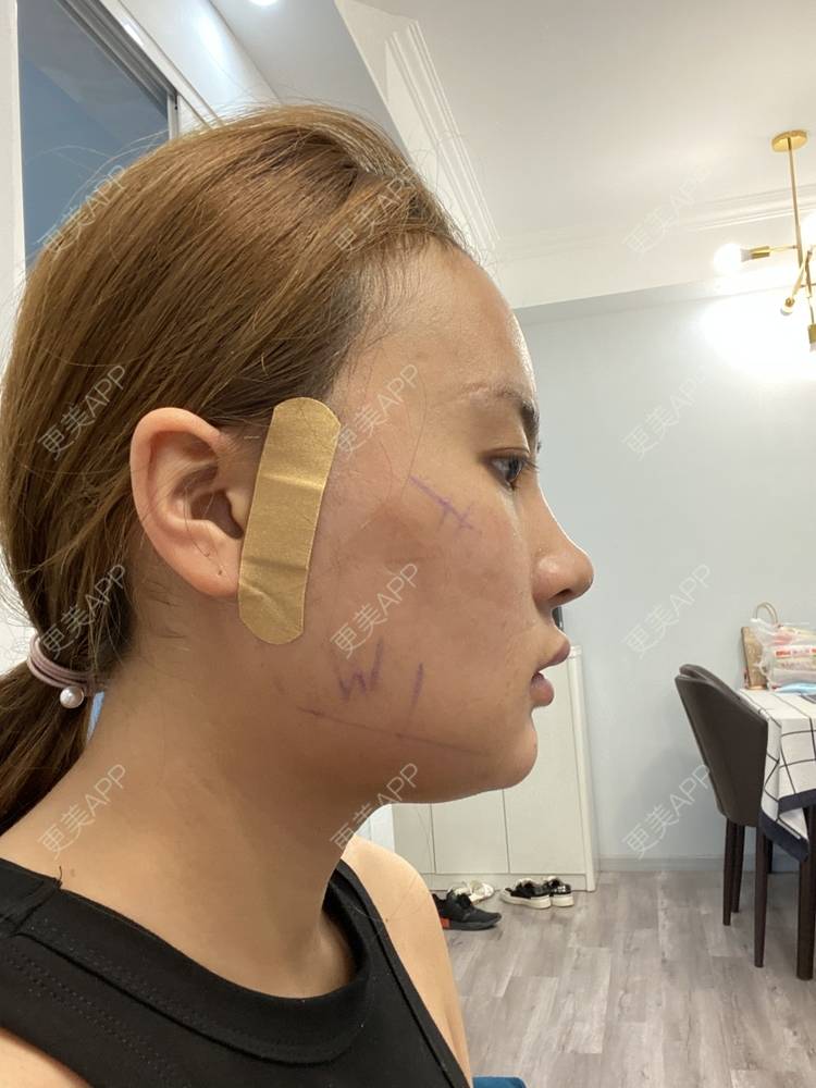 颧骨磨骨是怎么样磨的_颧骨磨骨_磨颧骨多少钱