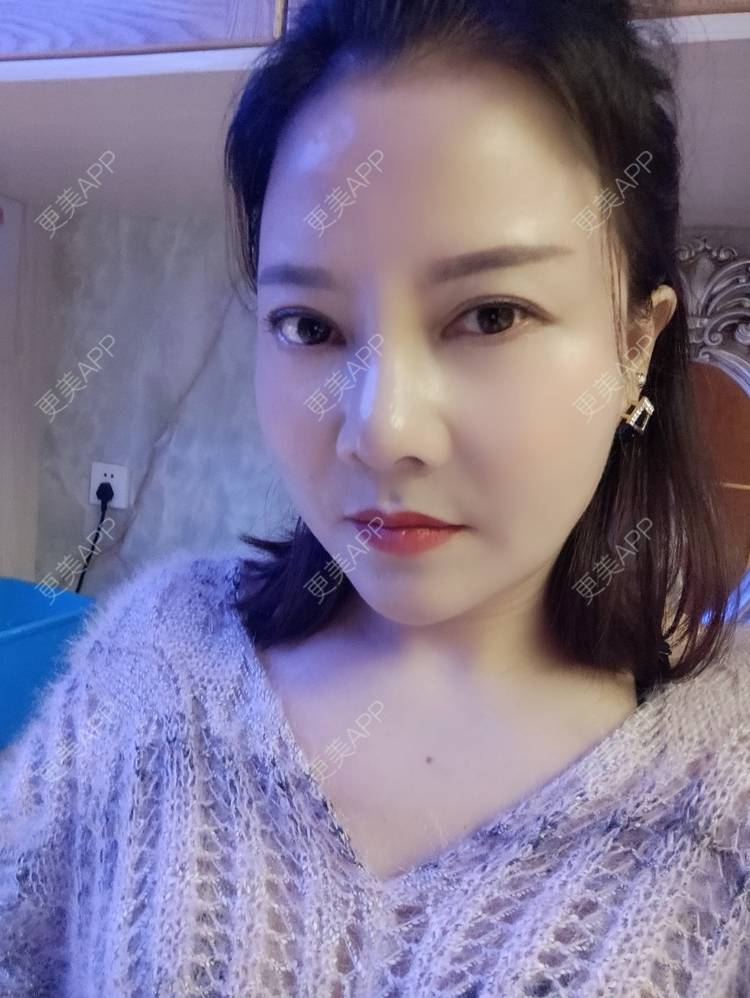 更美 - 更美用户xZI1wSP5Ch的隆鼻经验 | 隆鼻 | 肋软骨隆鼻 | 上海 | 自体肋软骨垫鼻基底