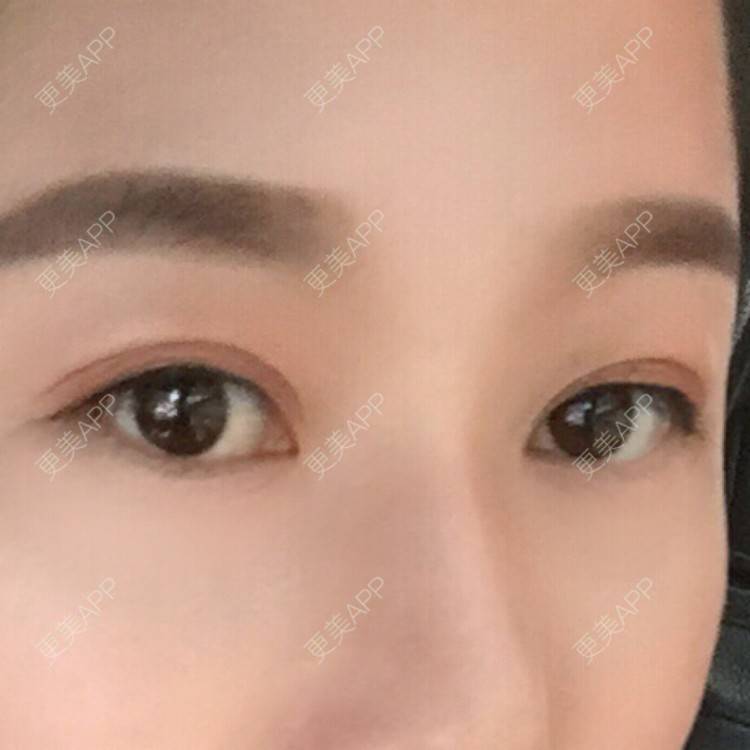 更美 - 更美用户S0fheYpMJT的瘦脸除皱经验 | 贵阳 | 瘦脸除皱